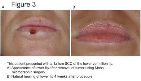 Lip skin cancer melanoma